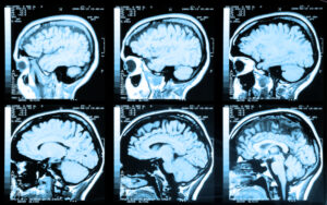 St. Clair Law Group handles cases of traumatic brain injury victim from auto accidents. Medical image of an MRI / MRA (Magnetic Resonance Angiogram) of the head showing the brain